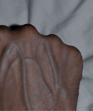 5 egészségügyi probléma, ami látható vénákat okozhat