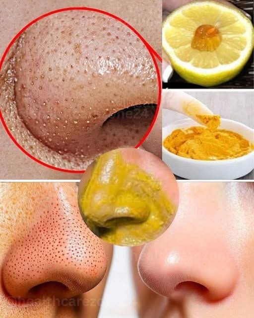 Mondj búcsút a mitesszereknek és a pattanásoknak! Küzdj ellenük természetesen otthon… Ha továbbra is szeretnél recepteket kapni, egyszerűen hagyj egy hozzászólást… Köszönöm!