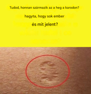 Miért hagyott heget a Variola vakcina?