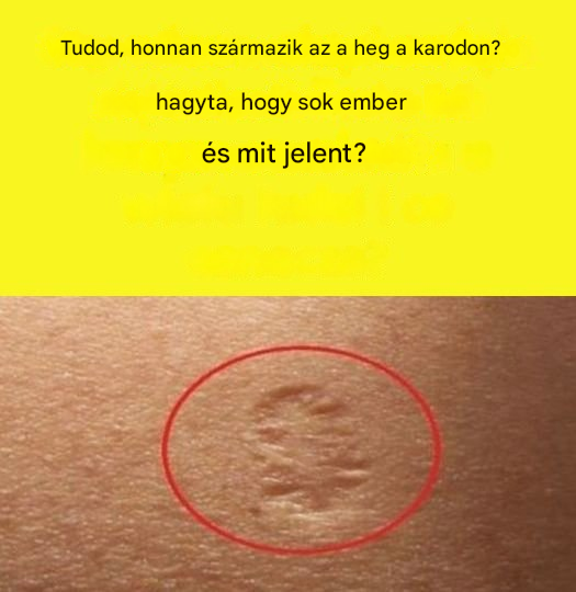 Miért hagyott heget a Variola vakcina?