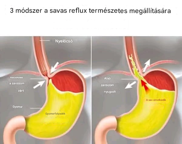 3 természetes módszer a reflux leállítására – lásd a hozzászólást…